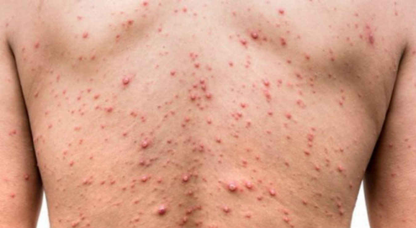 Casos de sífilis crescem no Brasil e acendem alerta para avanço da doença