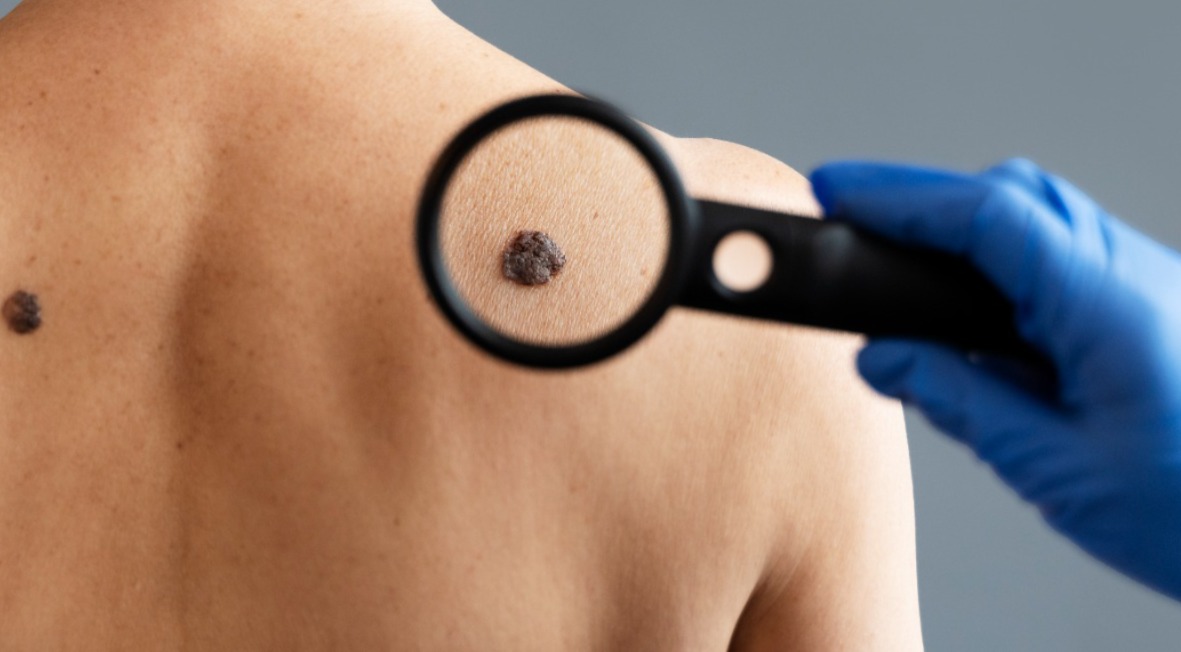 Homens e mulheres desenvolvem câncer de pele em regiões diferentes do corpo