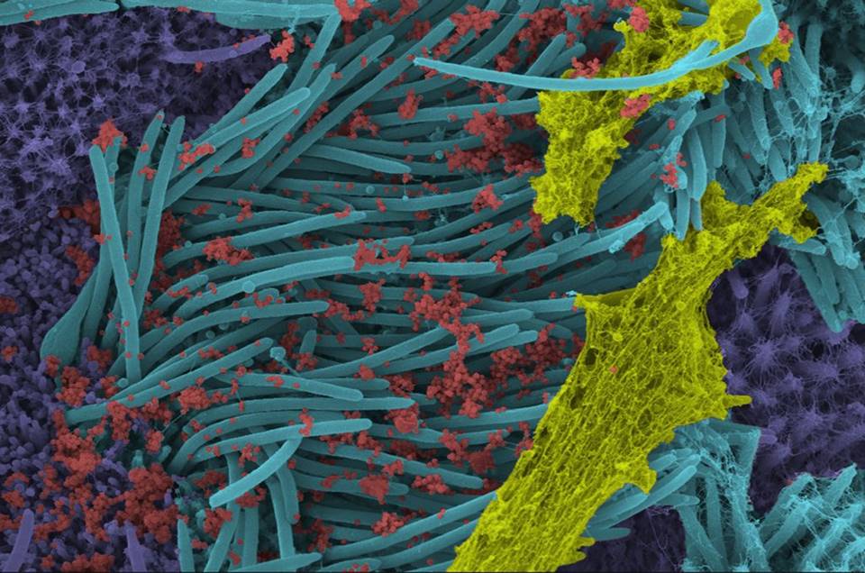 Imagens impressionantes mostram infecção por coronavírus nas células das vias respiratórias
