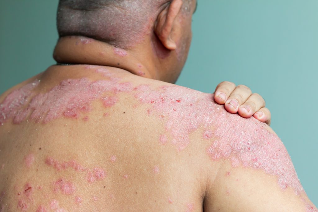 Novo tratamento brasileiro para hanseníase acelera cura e pode ser adotado pelo SUS