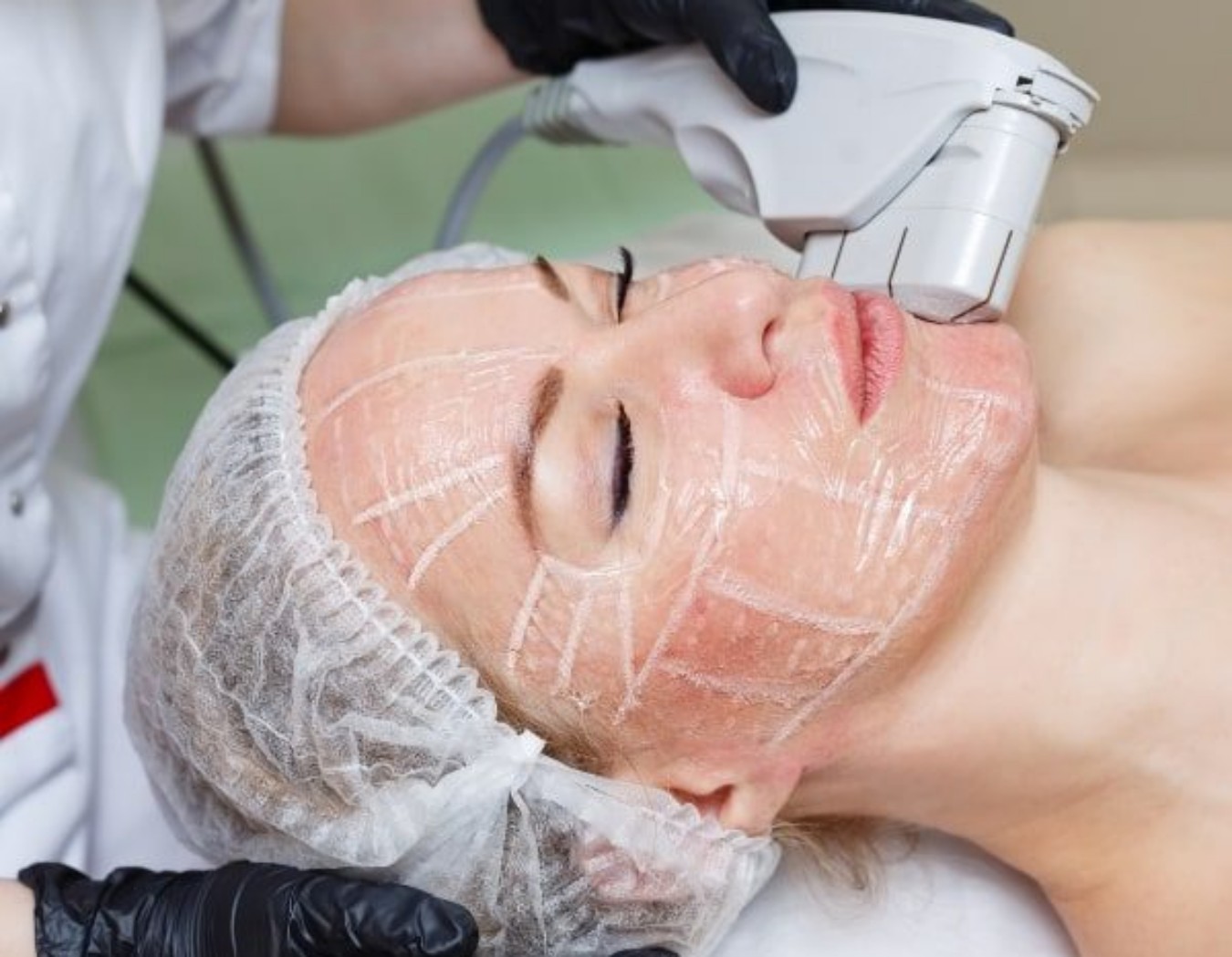 O ultrassom se torna essencial para aumentar a segurança e evitar danos graves em preenchimentos faciais