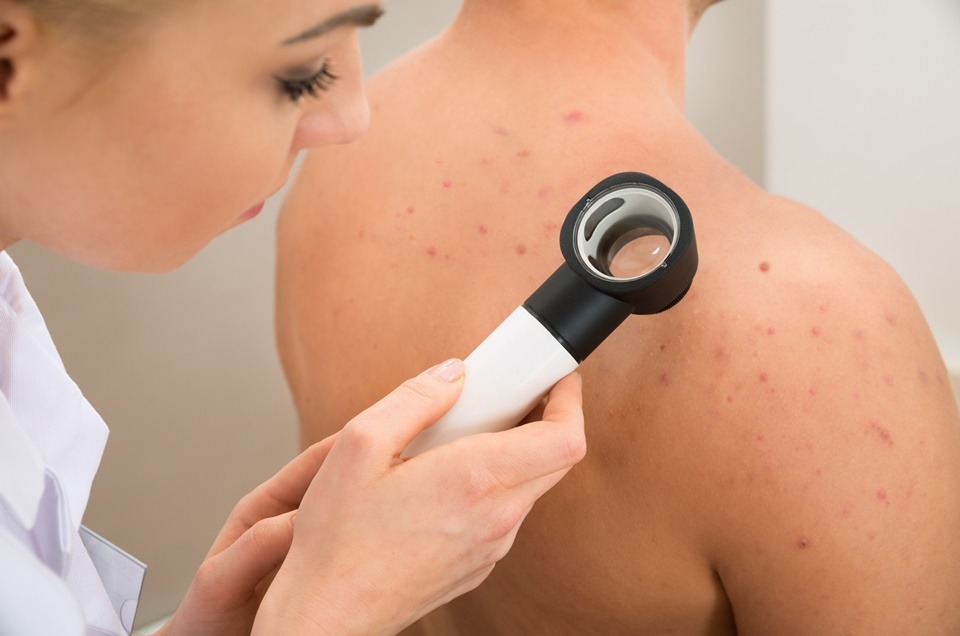 Câncer de pele – triagem e tratamento imediato podem salvar sua vida