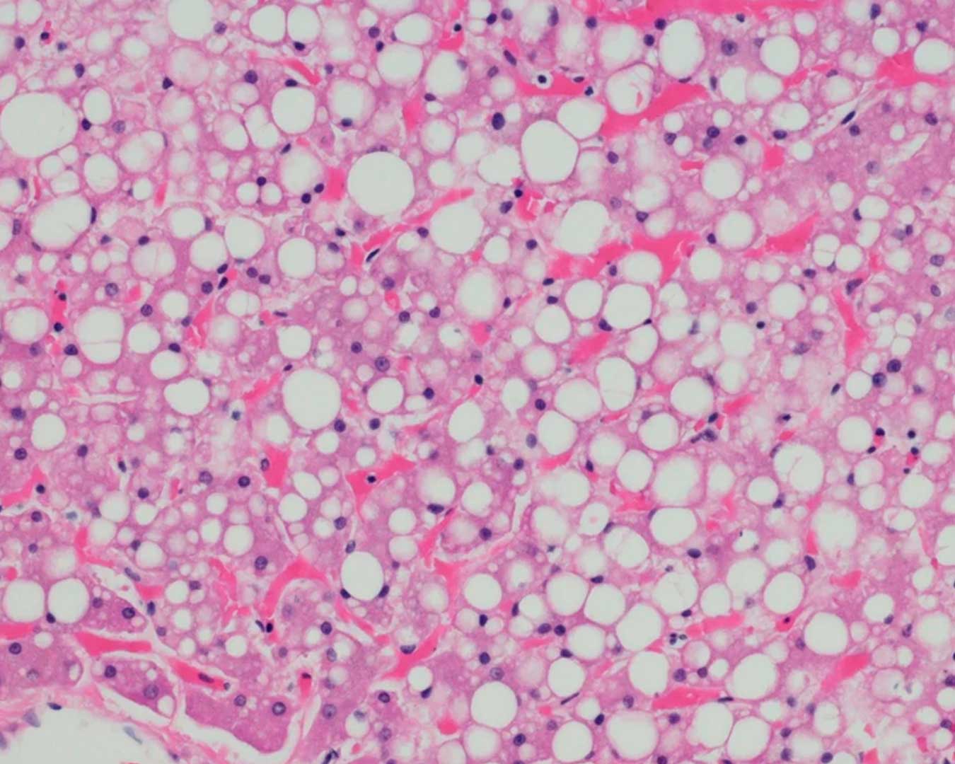 Pesquisa francesa mostra que obesidade e lipodistrofia têm origem metabólica comum