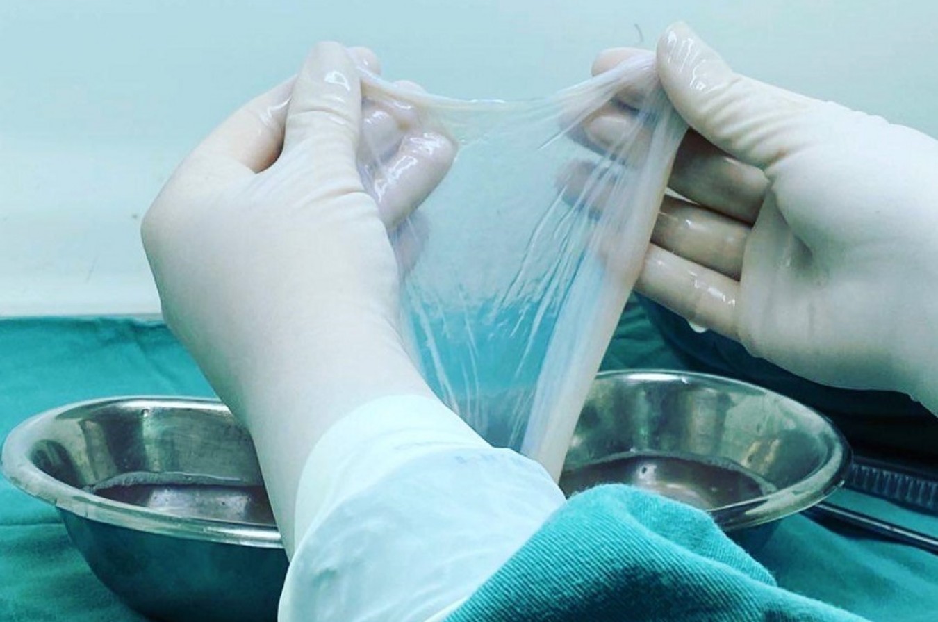 SUS incorpora membrana amniótica e amplia tratamento de feridas e doenças oculares