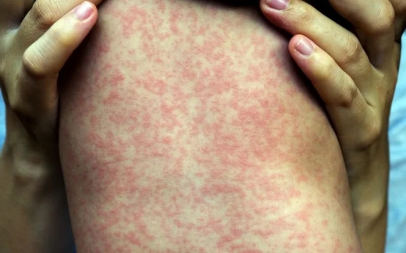 Sarampo volta a ameaçar o Brasil e farmacêutico ganha protagonismo na prevenção e identificação de casos