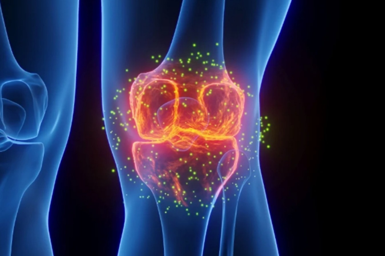 Terapia injetável experimental pode mudar a forma de tratar a osteoartrite