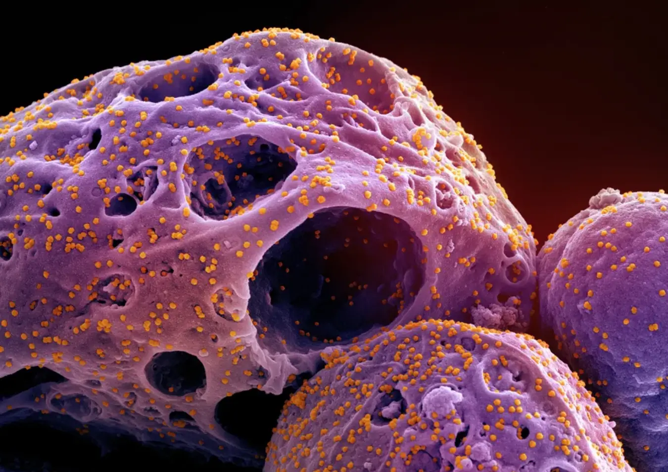 Variante BA.3.2 do SARS-CoV-2 é monitorada por maior capacidade de escape imunológico