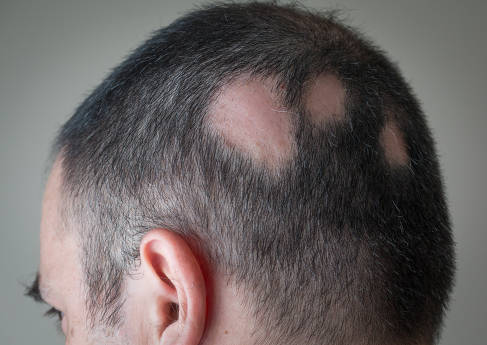 Anvisa aprova medicamento para tratar alopecia areata grave