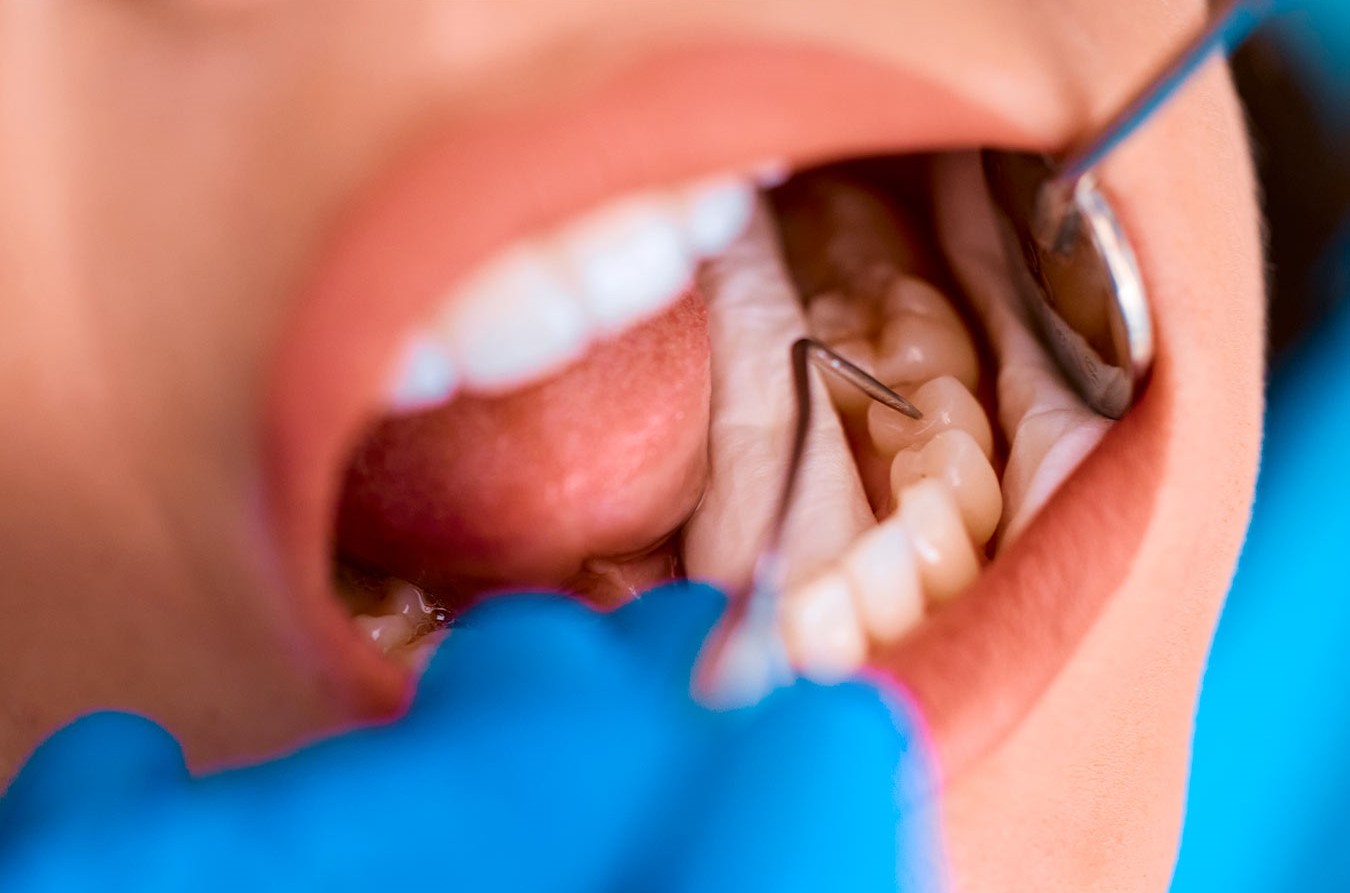 Pesquisadores desenvolvem flúor capaz de regenerar dentes danificados pela cárie