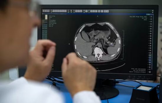 IA desenvolvida na China revela tumores mortais em tomografias comuns