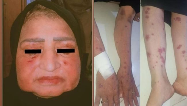 Ibuprofeno causa reação alérgica grave e faz mulher chorar lagrimas de pus.