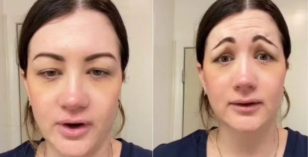 Aplicação de toxina botulínica dá errado e mulher fica com cara de “palhaço triste”