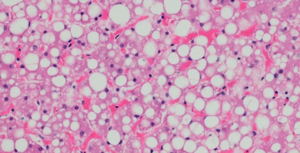 Pesquisa francesa mostra que obesidade e lipodistrofia têm origem metabólica comum