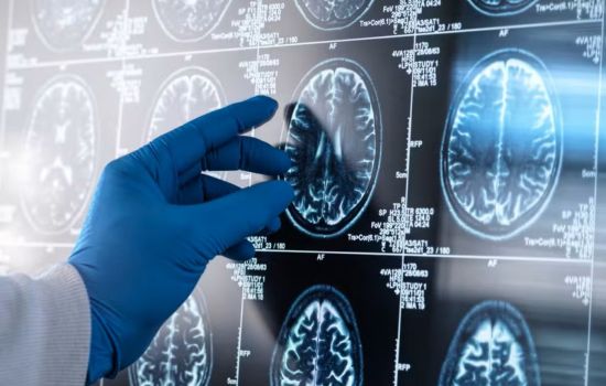 Estudo brasileiro revela que a inflamação no cérebro pode ser a chave para a progressão do Alzheimer.