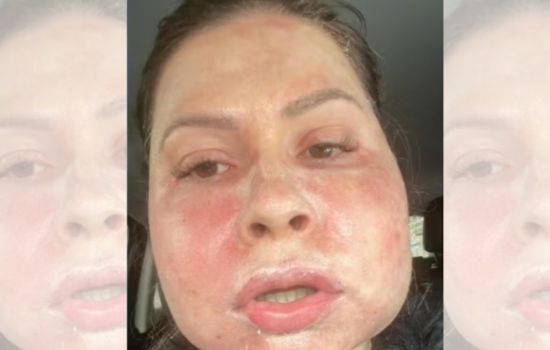 Farmacêutico e médica se defendem judicialmente, após denúncia de deformidade facial de paciente