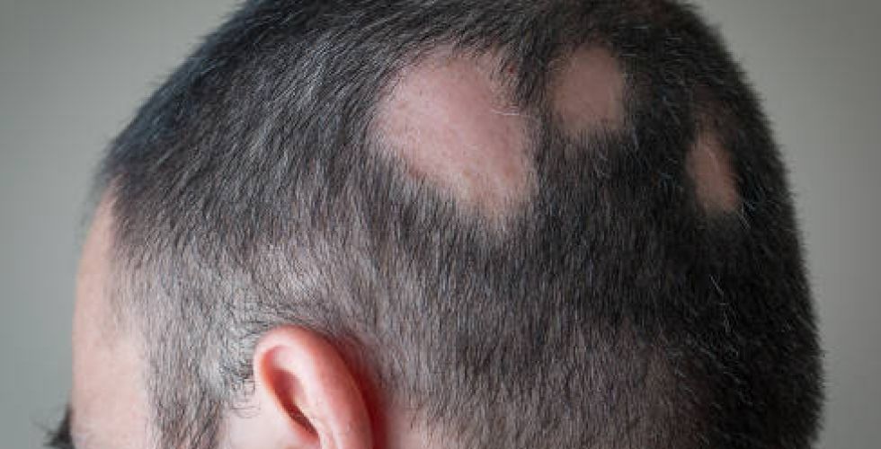 Anvisa aprova medicamento para tratar alopecia areata grave.