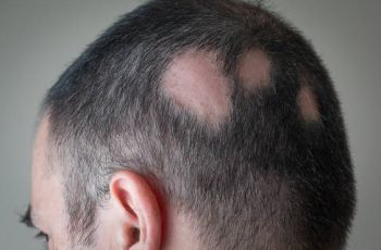 Anvisa aprova medicamento para tratar alopecia areata grave.