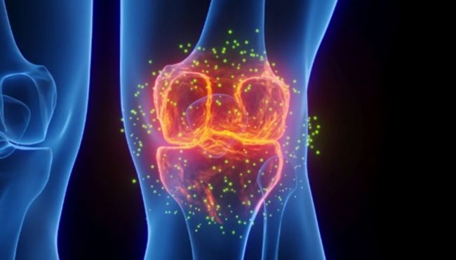 Terapia injetável experimental pode mudar a forma de tratar a osteoartrite