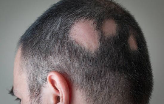Anvisa aprova medicamento para tratar alopecia areata grave.