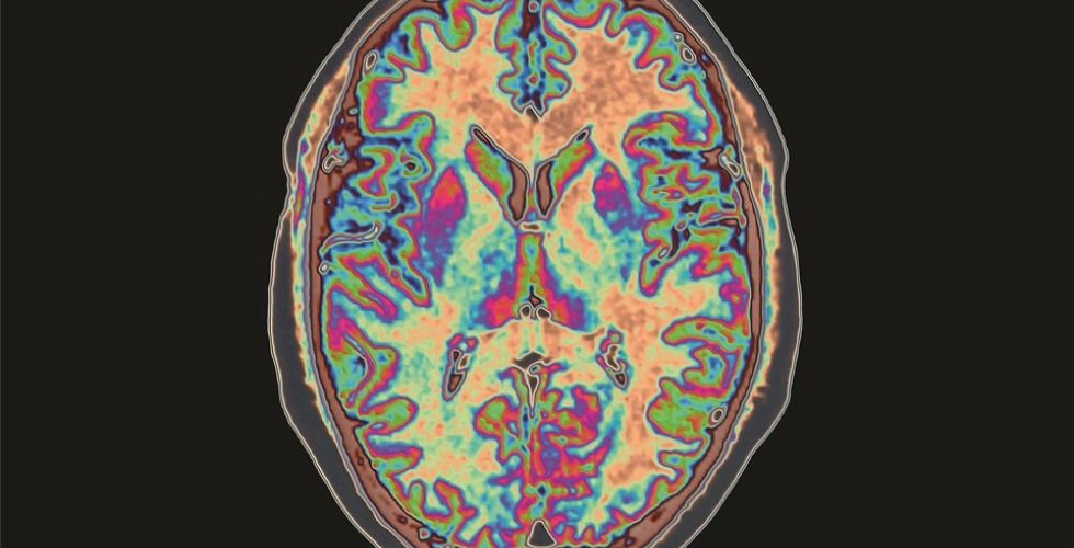 Droga que combate Alzheimer volta à cena como nova promessa