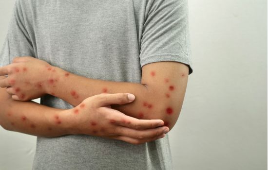 Casos de mpox chegam a 140 no Brasil em 2026