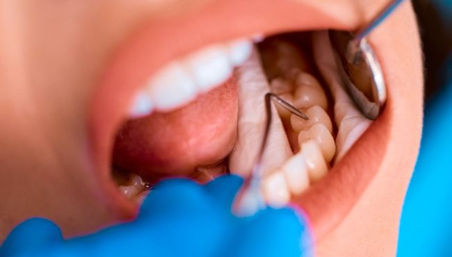 Pesquisadores desenvolvem flúor capaz de regenerar dentes danificados pela cárie