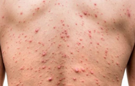 Casos de sífilis crescem no Brasil e acendem alerta para avanço da doença