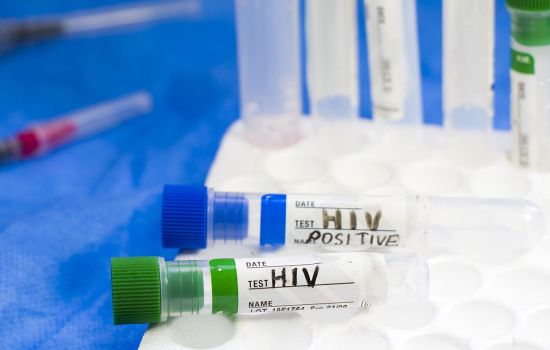 Pesquisadores descobrem nova variante do HIV combinando subtipos predominantes no Brasil