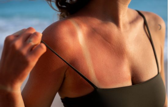 Movimento anti-protetor solar cresce: farmacêutico reforça alerta contra fake news e câncer de pele