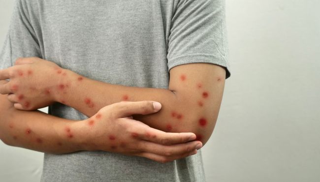 Casos de mpox chegam a 140 no Brasil em 2026