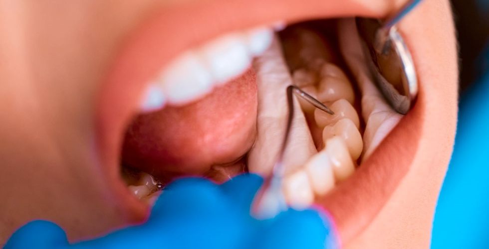 Pesquisadores desenvolvem flúor capaz de regenerar dentes danificados pela cárie