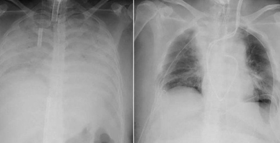 Japão faz 1º transplante de pulmão de doador vivo para paciente com coronavírus