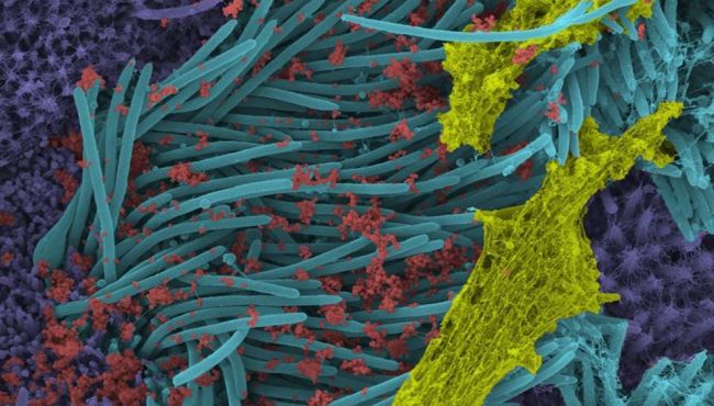 Imagens impressionantes mostram infecção por coronavírus nas células das vias respiratórias