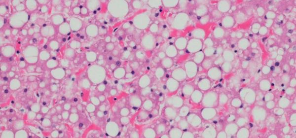 Pesquisa francesa mostra que obesidade e lipodistrofia têm origem metabólica comum