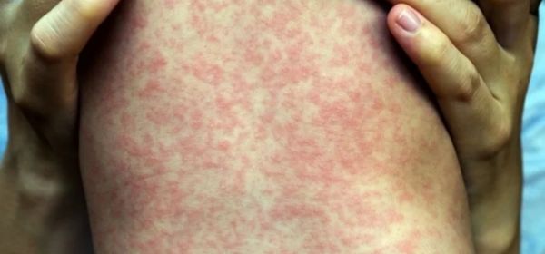 Sarampo volta a ameaçar o Brasil e farmacêutico ganha protagonismo na prevenção e identificação de casos