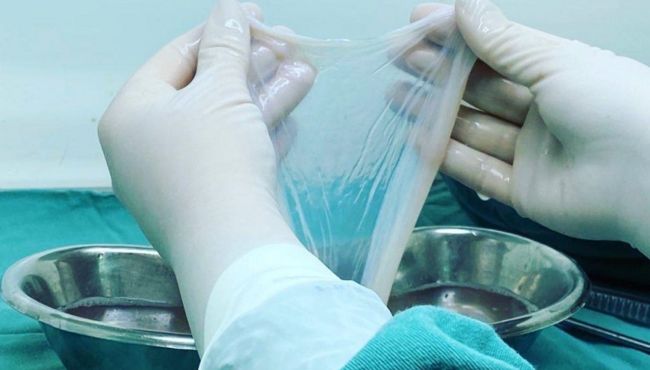 SUS incorpora membrana amniótica e amplia tratamento de feridas e doenças oculares