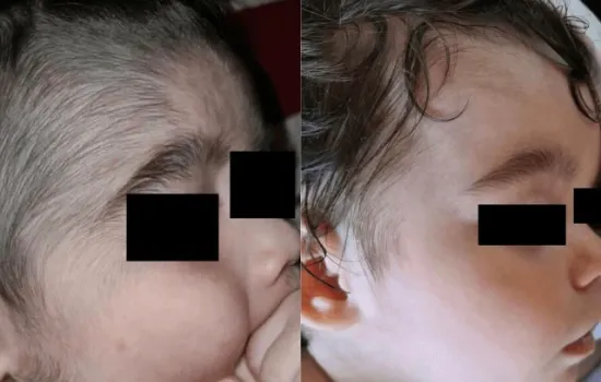 Contato indireto com minoxidil provoca 'síndrome do lobisomem' em 11 bebês