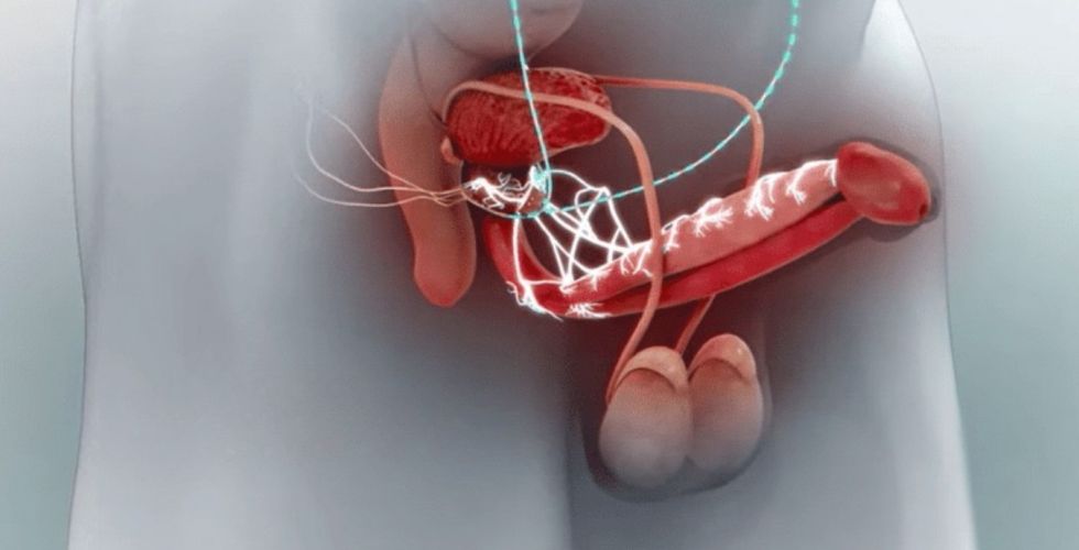 Viagra eletrônico: dispositivo criado por brasileiro recupera a ereção em 90% dos pacientes em estudo