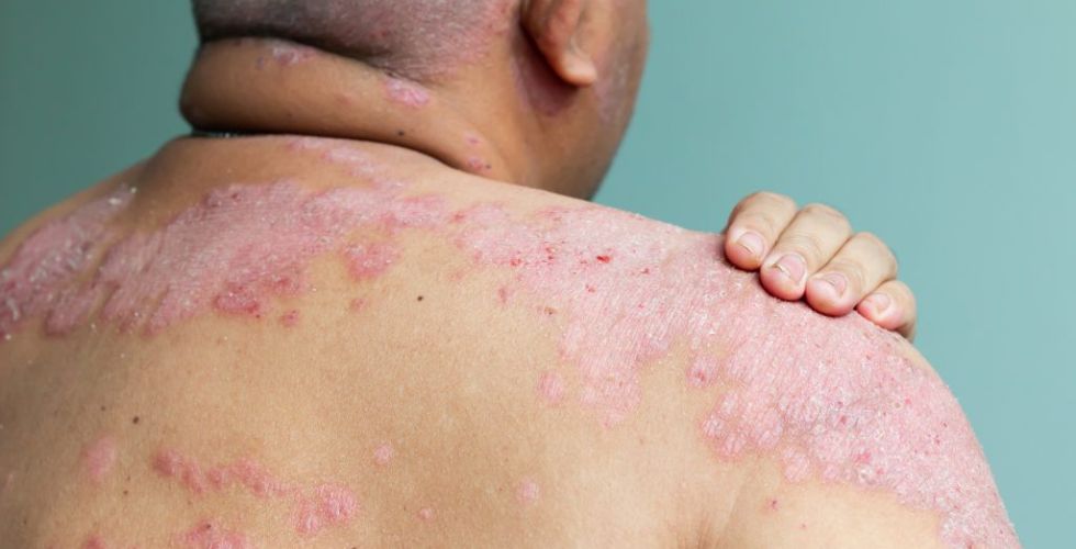 Novo tratamento brasileiro para hanseníase acelera cura e pode ser adotado pelo SUS