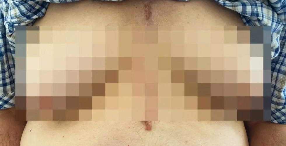 Uso de espironolactona é associado à ginecomastia em pacientes idosos