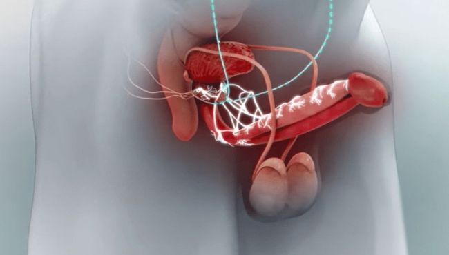 Viagra eletrônico: dispositivo criado por brasileiro recupera a ereção em 90% dos pacientes em estudo