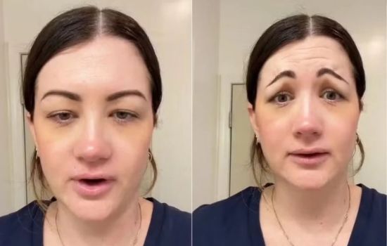 Aplicação de toxina botulínica dá errado e mulher fica com cara de “palhaço triste”