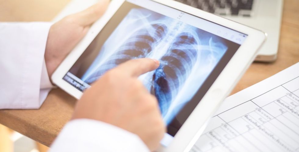 Anvisa aprova novo medicamento para câncer de pulmão