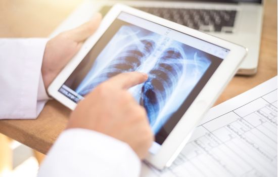 Anvisa aprova novo medicamento para câncer de pulmão