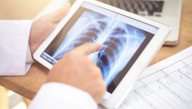 Anvisa aprova novo medicamento para câncer de pulmão