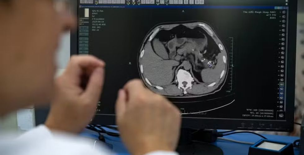 IA desenvolvida na China revela tumores mortais em tomografias comuns