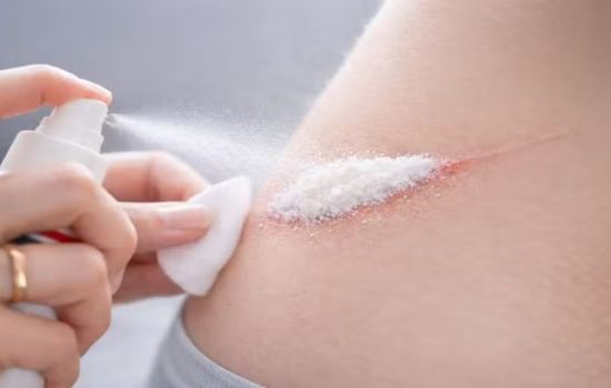 Pesquisadores criam spray capaz de estancar hemorragias em segundos