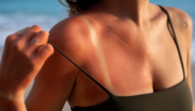 Movimento anti-protetor solar cresce: farmacêutico reforça alerta contra fake news e câncer de pele