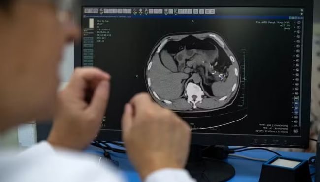 IA desenvolvida na China revela tumores mortais em tomografias comuns