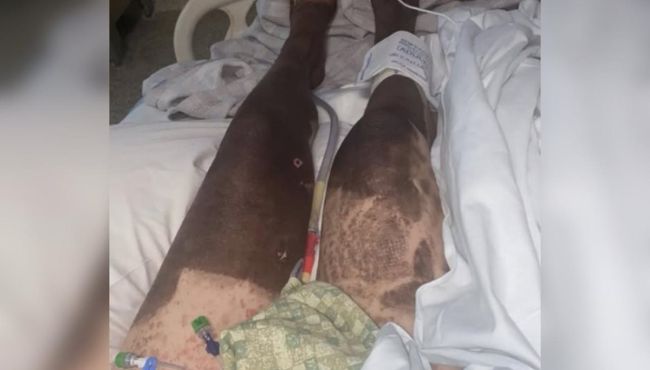 Mulher perde 95% da pele após reação ao ibuprofeno